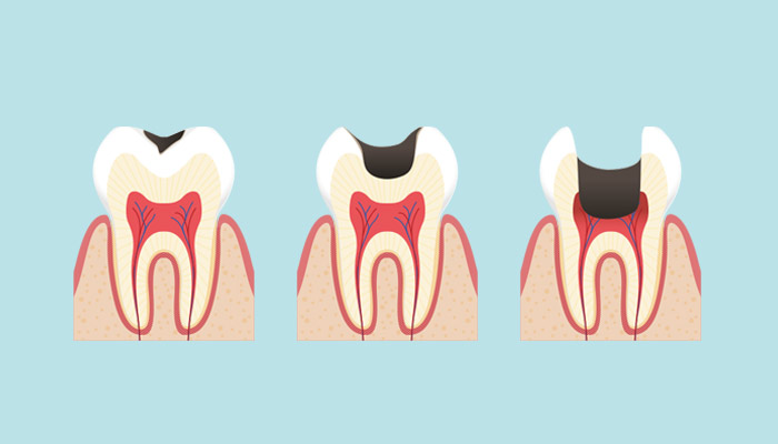 むし歯の進行を表すイラスト
