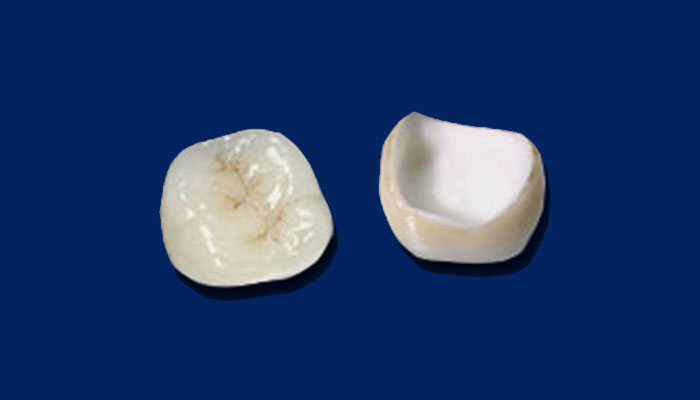 オールセラミック