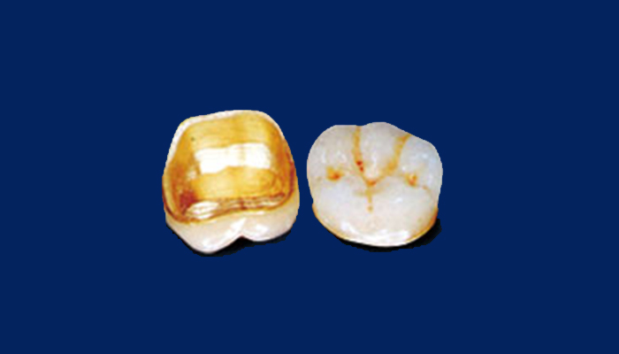 メタルセラミック