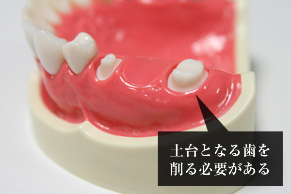 違いその1：健康な歯を削らない