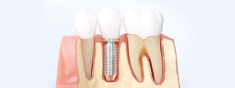 当院のインプラント治療メニュー