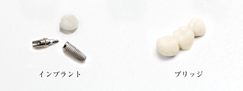 インプラントとブリッジの違い