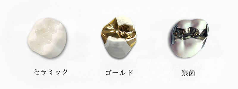 セラミック・ゴールド・銀歯の比較画像
