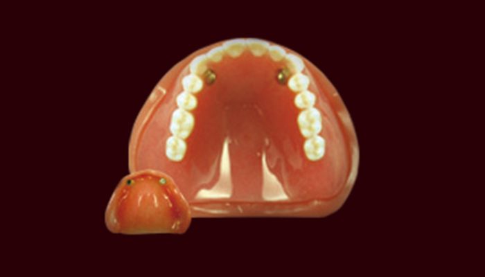 磁性アタッチメント(維持装置)の画像