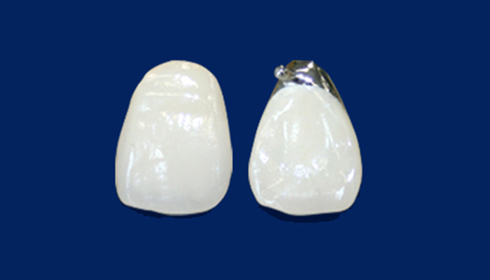 メタルセラミック