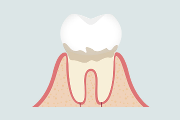 歯肉炎を説明するイラスト