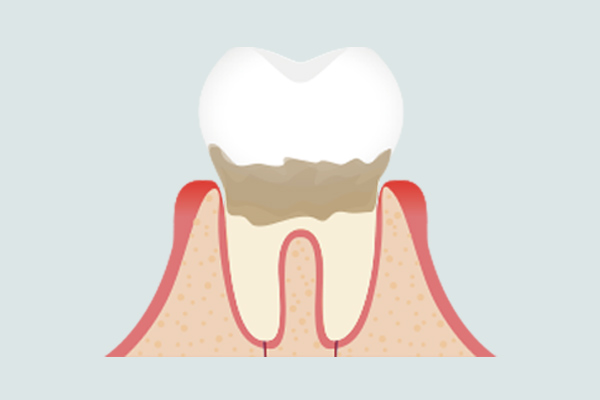132.481637歯肉炎を説明するイラスト