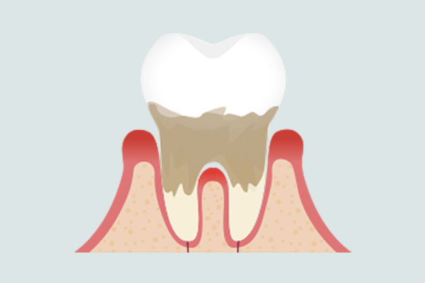中度歯肉炎を説明するイラスト