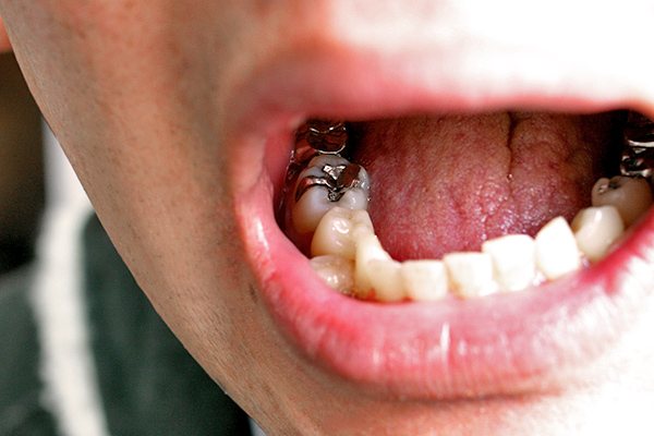 実際の奥歯の銀歯が見える画像