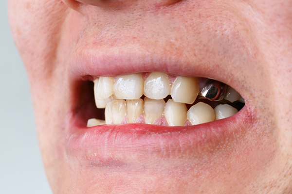 実際のかぶせた銀歯が見える画像